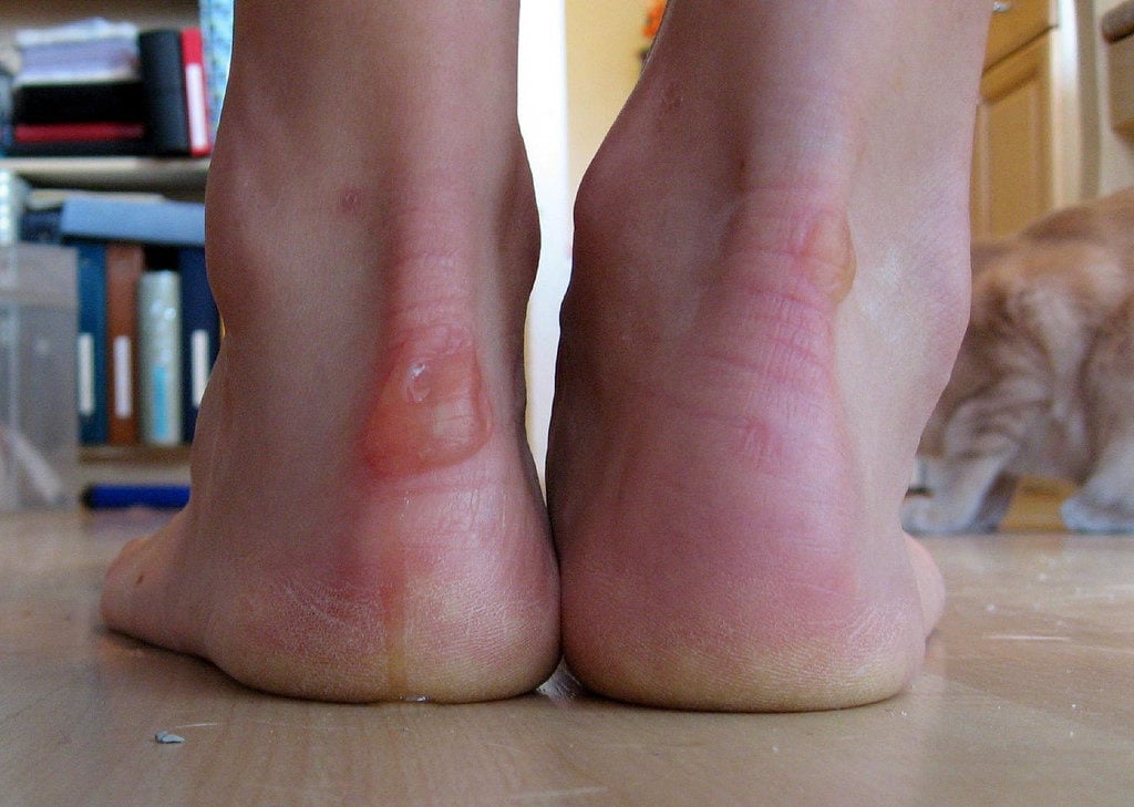 Blisters on the heel of a hiker's foot. Find out how to prevent blisters when hiking, and how to treat blisters on the trail.