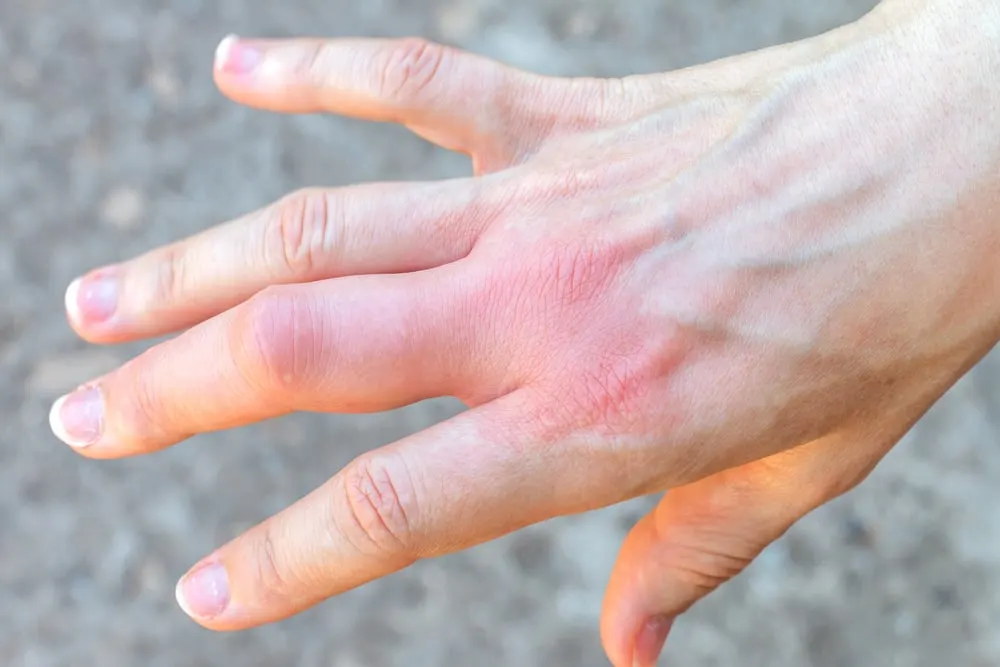 A hand with swelling from a wasp sting. Watch out for wasps while hiking.